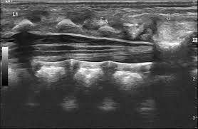 Image result for Spinal Dysraphism