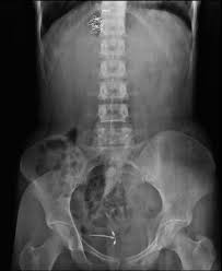 Medical abbreviations / acronym search. Intrauterine Contraceptive Device Radiology Reference Article Radiopaedia Org