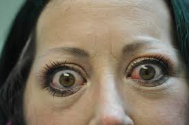 Image result for Proptosis