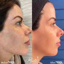 MELT Lipotherapy + Wellness Spa