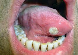 Image result for mouth ulcer on tongue)