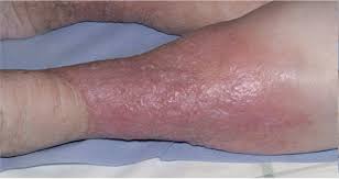 Image result for Lipodermatosclerosis