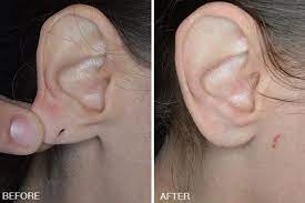Earlobe Repair Surgery Miami Split Earlobe Procedure Florida