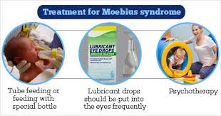 Objective to improve diagnostic assessment in moebius syndrome by (1) creating more selective diagnostic subgroups and (2) conducting genetic evaluation in a large patient. Moebius Syndrome Causes Symptoms Diagnosis Treatment Prevention