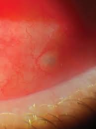 Image result for Conjunctival Foreign Body