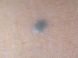 Image result for Blue Nevus
