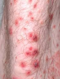 Purpura rash the rash that is associated with purpura is sometimes referred to as either skin hemorrhages or blood spots. Henoch Schonlein Purpura Causes Symptoms Prognosis Treatment