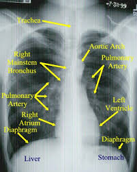Check spelling or type a new query. Chest X Ray