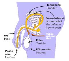 Image result for Vasectomy