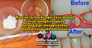 Gigi anjing yang memiliki karang gigi yang berkarang juga menjadi sarang bakteri sehingga mulut sebab itu harus diatasi dengan cara berikut, 12 cara menghilangkan karang gigi pada anjing. Ini Tips Untuk Hilangkan Karang Gigi Guna Bahan Mudah Ini Saja Gigi Akan Jadi Putih Dan Bersih Berita Kopak