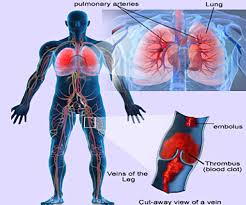 Pulmonary Embolism And Deep Vein Thrombosis Venous