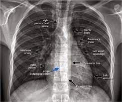There are also important structures that are obscured or become visible. Chest X Ray Part 1 Normal Anatomy And Itsvariants Radiology Radiology Imaging X Ray