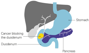 Most pancreatic cancers are of this type. Feeling And Being Sick At The End Of Life Pancreatic Cancer Uk