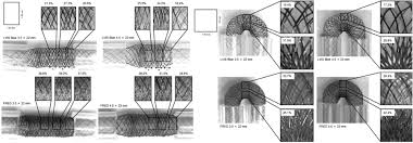 Big time rush avant et apr s 2019 big time rush s rie t l vis e скачать. A Comparison Between The New Low Profile Visualized Intraluminal Support Lvis Blue Stent And The Flow Redirection Endoluminal Device Fred In Bench Top And Cadaver Studies Journal Of Neurointerventional Surgery