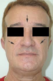 And one thing to do this is to be always ready. Laser Treatment For Orange Peel Texture Of The Skin