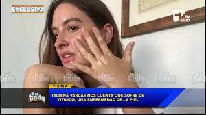 Taliana Vargas muestra la enfermedad que tiene en la piel | #LoSéTodo La  exreina colombiana muestra las secuelas que tiene en su piel tras el  embarazo. | By Canal1 | Facebook