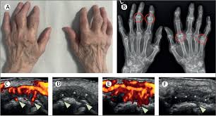 Image result for XRay Changes in Rheumatic Conditions