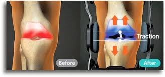 Easy returns · team discounts available · great prices & selection Knee Braces Supports For Pain Relief Stability Traction