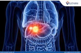Transarterial Chemoembolization (TACE), Alternative Chemotherapeutic Agent  Given Through Artry for Precise Liver Cancer Treatment - Vejthani  International Hospital | JCI Accredited International Hospital in Bangkok,  Thailand.