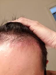 Soothe your itching and control your scales with scalp psoriasis shampoos, drugs, and home remedies. Is This Scalp Psoriasis Imgur