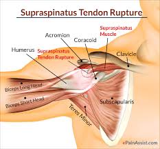 Shoulder is composed of 4 joints, namely glenohumeral or shoulder joint, acromioclavicular joint, sternoclavicular joint and scapulothoracic joint. Supraspinatus Rupture Treatment Causes Symptoms Diagnosis Supraspinatus Muscle Shoulder Anatomy Body Anatomy