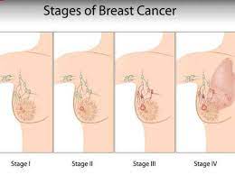 Dr.c.palanivelu is an expert surgeon from coimbatore (tamil nadu, india). Symptoms Of Breast Cancer à®® à®° à®ªà®•à®ª à®ª à®± à®± à®¨ à®¯ à®² à®®à®Ÿ à®Ÿ à®® à®‡à®¤ à®¤à®© à®µà®• à®¯ à®Žà®ª à®ªà®Ÿ à®µà®° à®µà®¤à®± à®• à®® à®© à®© à®¤à®Ÿ à®ª à®ªà®¤ World Cancer Day 2020 Symptoms And Types Of Breast Cancer In Tamil