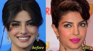 Priyanka Chopra Nose Job Before And After Picture Sekho In Priyanka chopra was recently trolled for wearing a short dress while meeting pm modi.