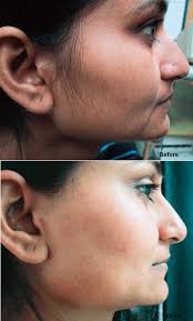 We talked to dermatologists to learn what causes facial hair in however, going through menopause isn't the only trigger for increased facial hair growth in women. Female Facial Hair Myths You Need To Stop Believing Alldaychic