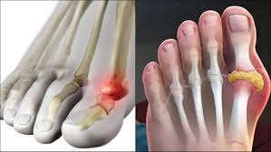 Image result for gout