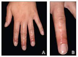 Using a vegetable peeler or paring knife, remove both the large spines on the pads, as well as the tinier ones that might be hard to see. Granulomatous Reaction After Cholla Cactus Spine Injury Mdedge Dermatology