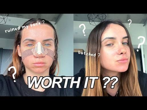 I got the MOST EXPENSIVE NOSE JOB in TURKEY is it WORTH IT??? - YouTube