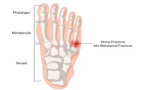 Image result for Metatarsal