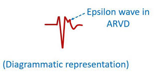 Image result for Epsilon Wave