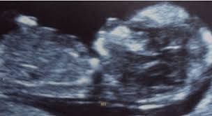 Nuchal scan (plural nuchal scans). Nuchal Translucency Nt Thickness Measurement Taken On Transabdominal Download Scientific Diagram