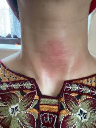 I've never ever gotten dead skin off like i be hearing with it smh. Used Korean Italy Towel For The First Time And Rubbed Way Too Hard Left With Painful Red Patch On Neck What Can I Do Misc Skincareaddiction