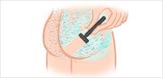 Shop our manscaping shaver today. How To Shave Your Butt Illustrated Bellatory