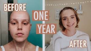 I finally have a dermatology appointment and my primary care provider prescribed me latisse for eyelashes and brows. One Year Post Chemo Hair Growth Lauren Mae Youtube