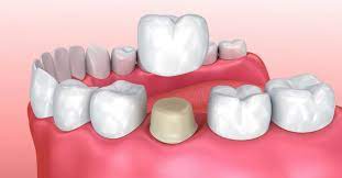 We did not find results for: What You Should Do If Your Dental Crown Falls Off Woodbridge