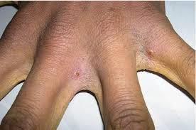 Image result for scabies norvegica
