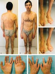 Image result for Myopathy