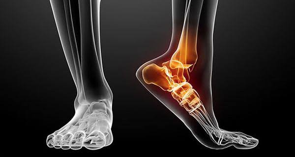 Hướng dẫn cách sơ cứu khi bị trật khớp