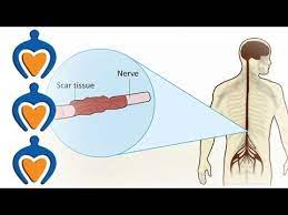 Many people with disability have multiple disabilities. Multiple Sclerosis Ms What Is Multiple Sclerosis Youtube