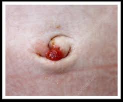 Image result for Umbilicus botryoides