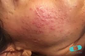 Résultat de recherche d'images pour "rosacea"