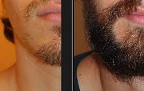 La greffe de barbe permet de corriger différents défauts tels que barbe irrégulière ou mal fournie et cicatrices. Greffe De Barbe