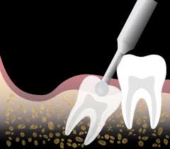 Image result for Alveolitis sicca)