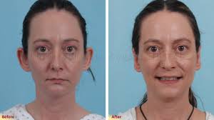 Otoplasty or Ear Surgery Photos