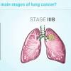 Most lung cancers don't cause symptoms until the disease has advanced, in part because the lungs have few nerve endings. 1