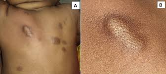 Image result for Urticaria pigmentosa children