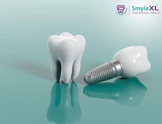 Dental Implant Treatment in Sinhagad Road, Pune | Smylexl